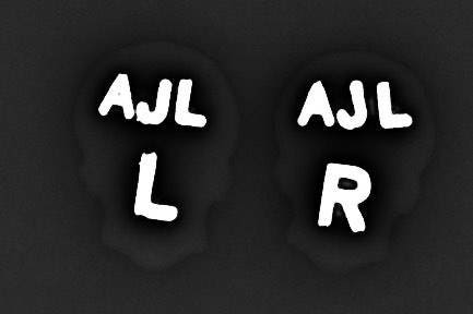 Xray Markers Sugar Skull Blue and Pink with Sparkles